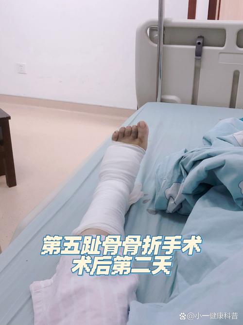 费尔明手术治疗第五跖骨骨折，恐无缘美加墨